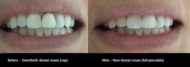 Dental crown before and after