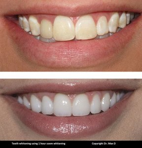 Teeth whitening oakville
