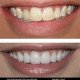 Teeth whitening oakville