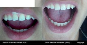 chipped tooth oakville