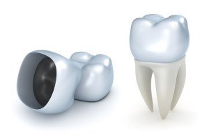 dental crowns