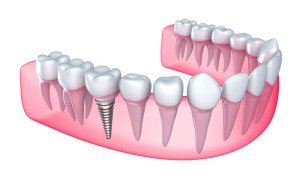 dental implant