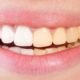 teeth whitening oakville