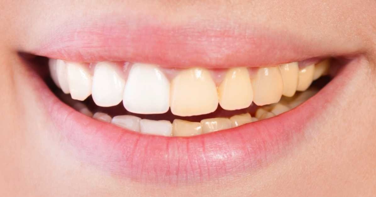 teeth whitening oakville