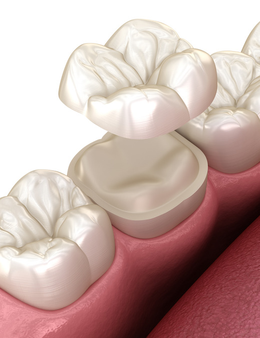 Dental crowns