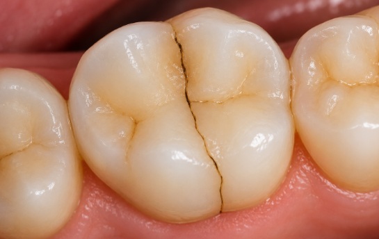 Close-up dental model showing a crack line in the middle of a tooth