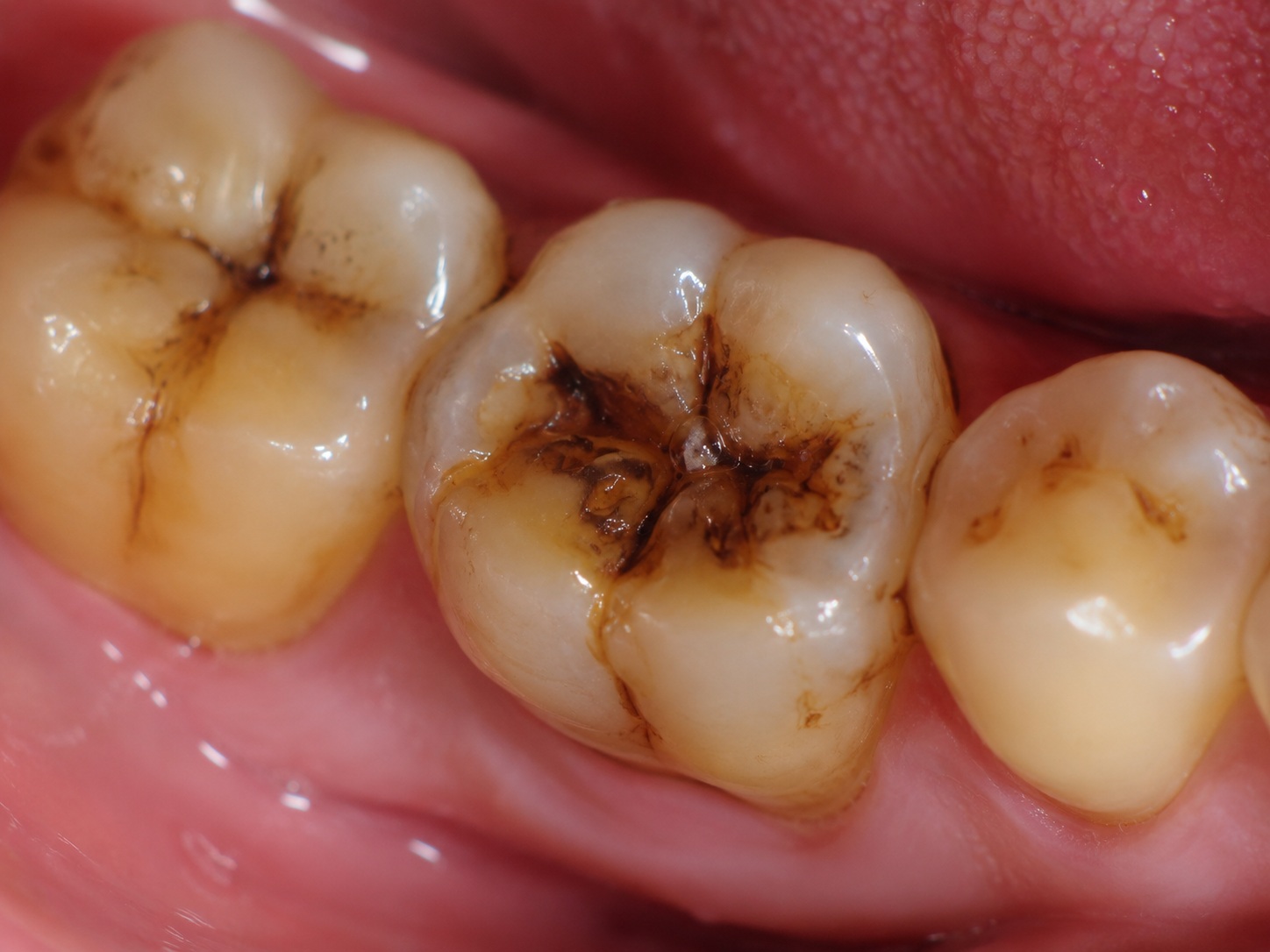 Close-up of teeth showing the difference between surface stains and deeper tooth colour
