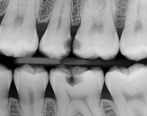 dental-xray-showing-cavities