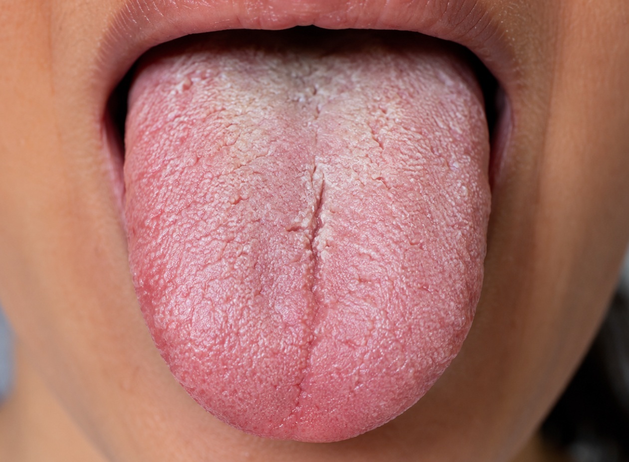A tongue shows signs of dry mouth